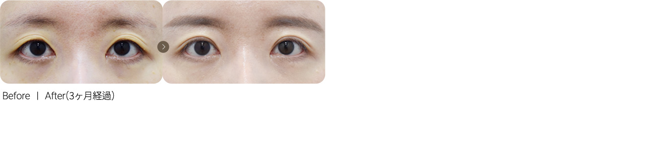 切开法修复 + 凹陷眼脂肪填充