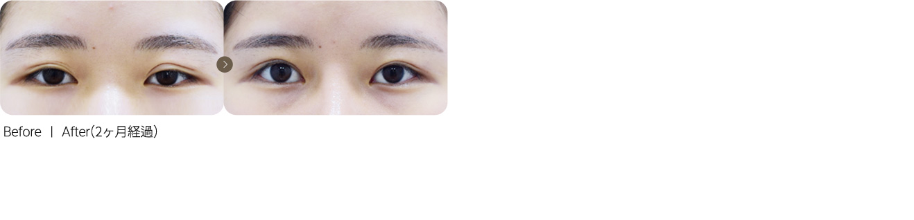 降低双眼皮线条