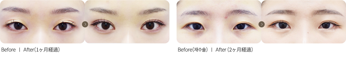 自然粘连双眼皮