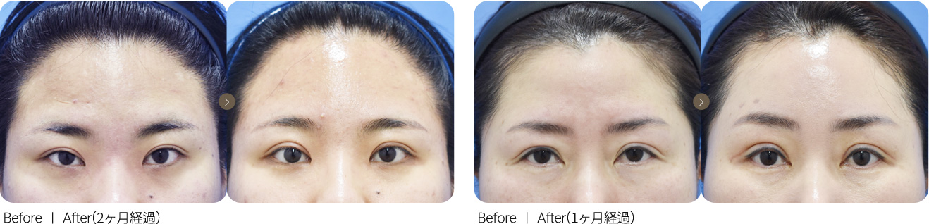 切开手术+额头提升