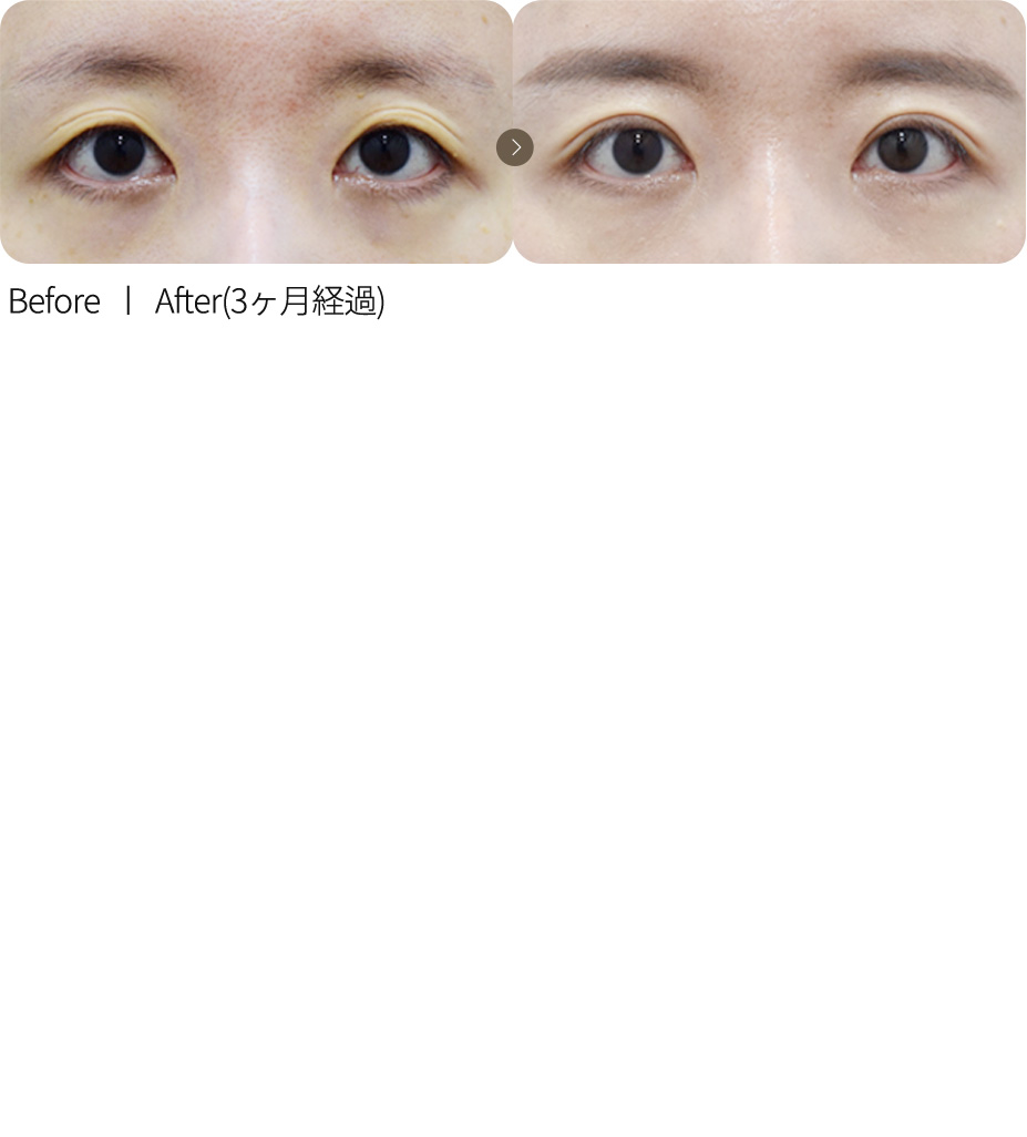 切开法修复 + 凹陷眼脂肪填充