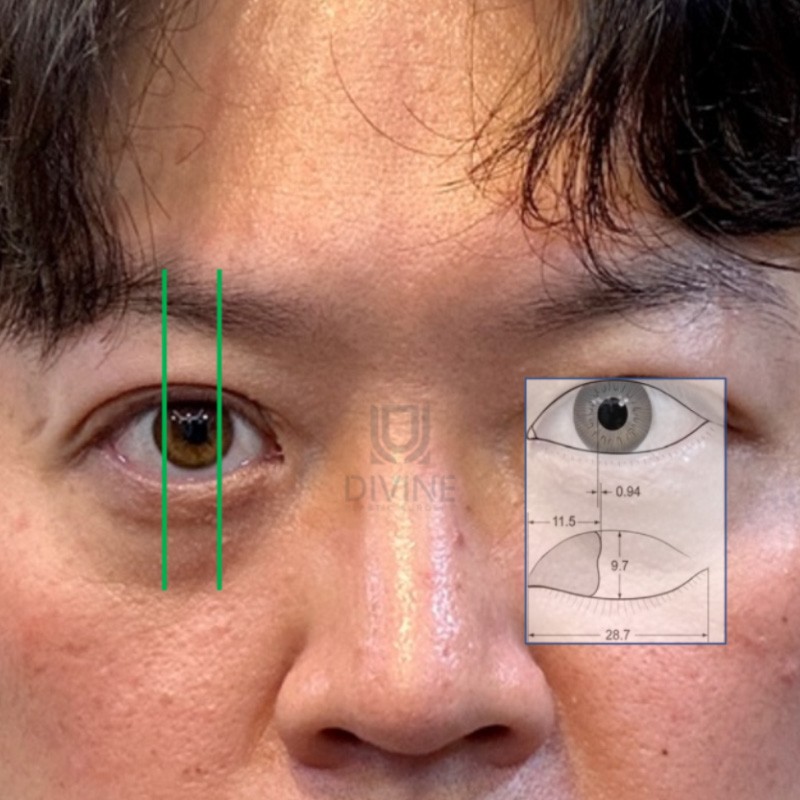 눈매교정 수술, 어떻게 하면 잘 할 수 있을까요?