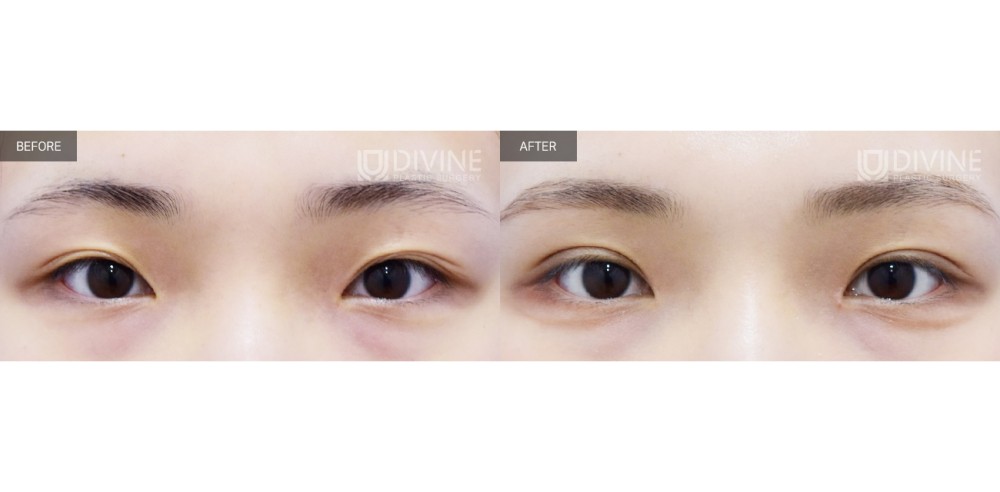 자연유착+앞트임 수술 전후 사진