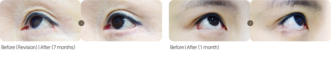 Lateral Canthoplasty Revision + Lovely Eye Surgery