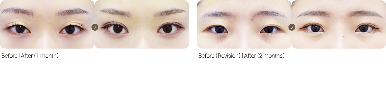 Natural Adhesion Double Eyelid