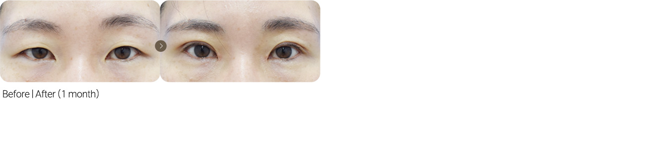 Incisional Eye Correction + Epicanthoplasty