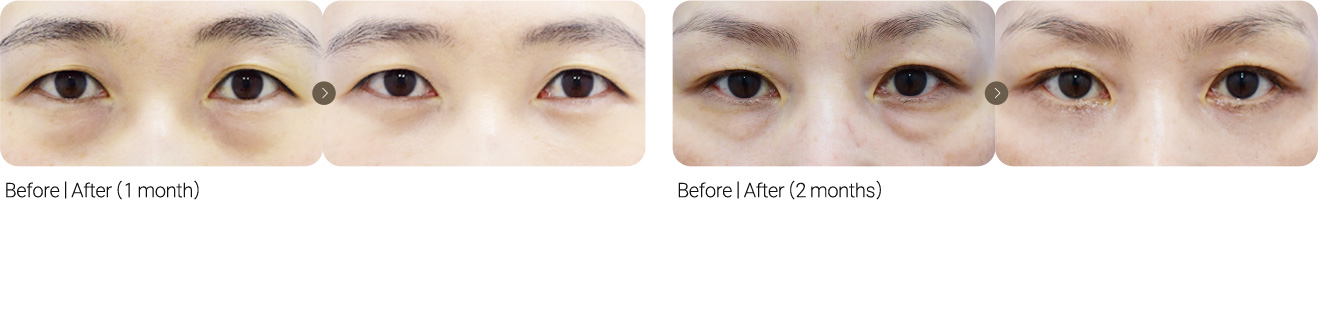 Lower Eyelid Surgery