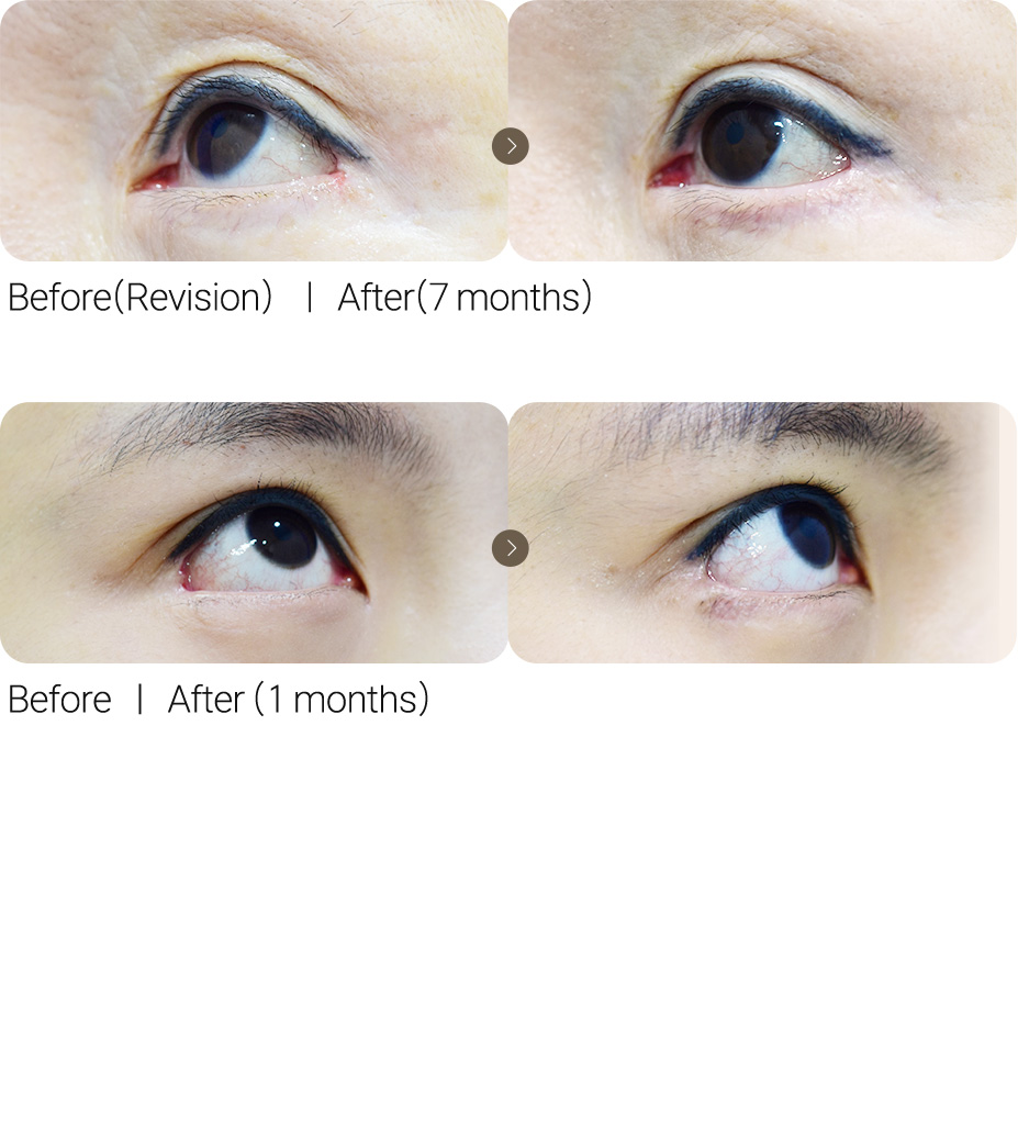 Lateral Canthoplasty Revision + Lovely Eye Surgery