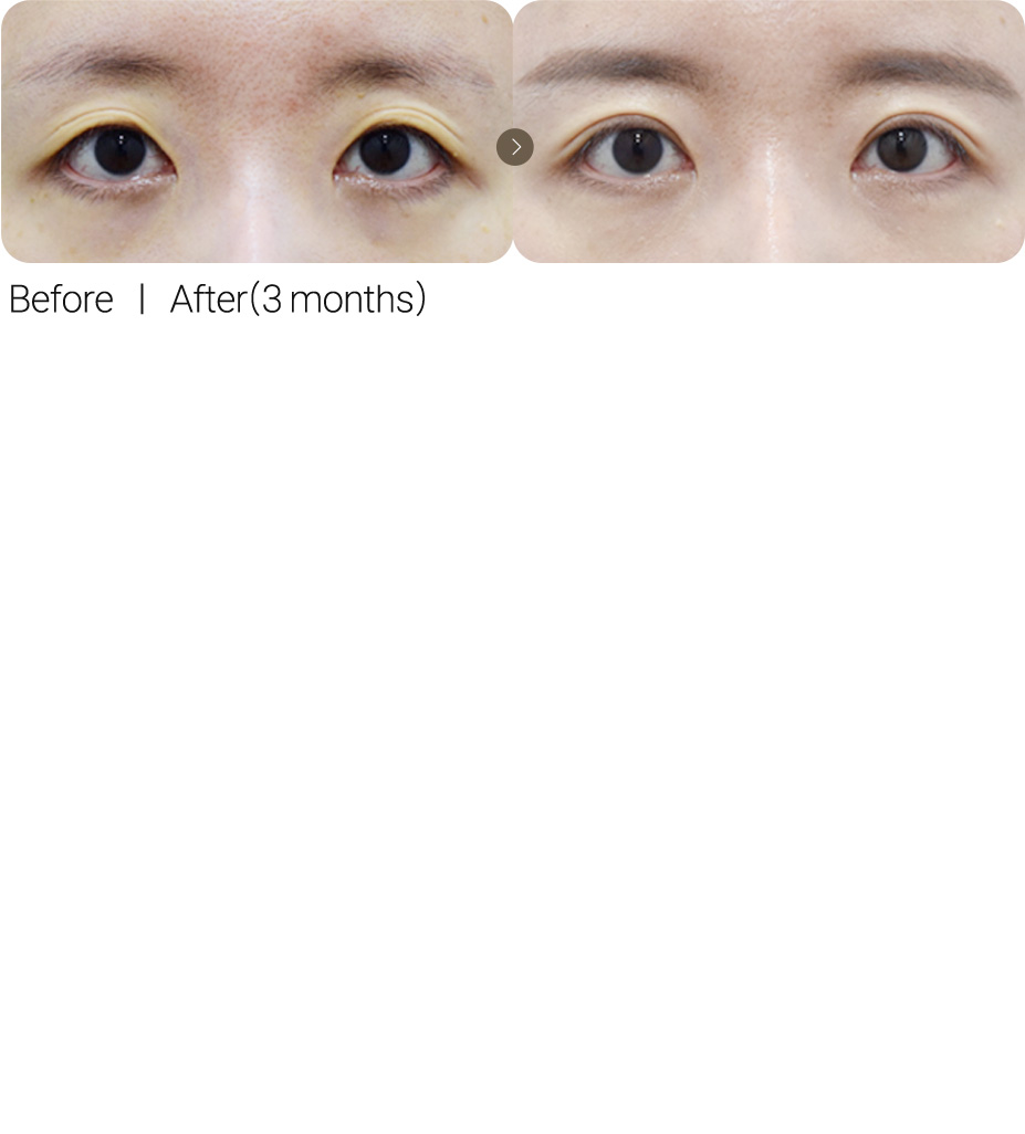 Incisional Revision + Fat Grafting for Hollow Eyes