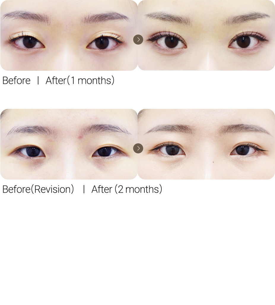 Natural Adhesion Double Eyelid