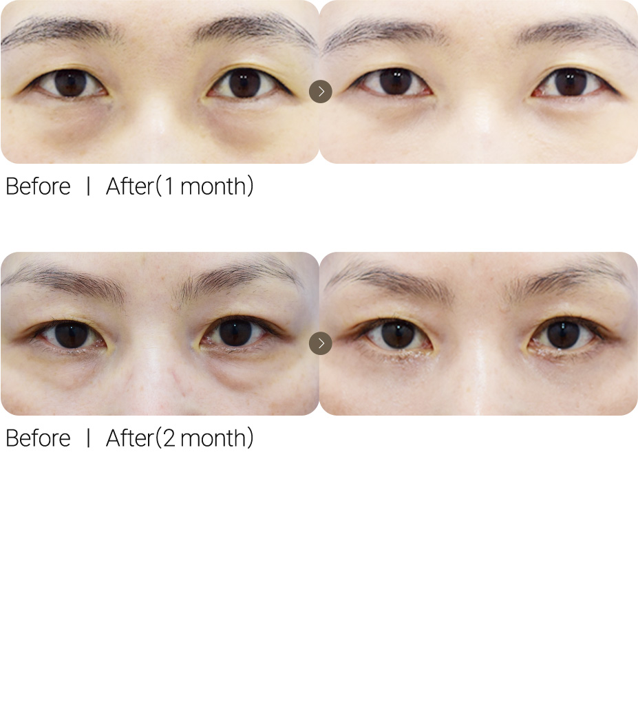Lower Eyelid Surgery