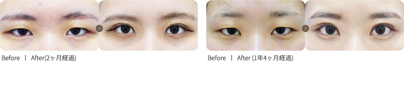 切開眼瞼矯正＋目頭切開