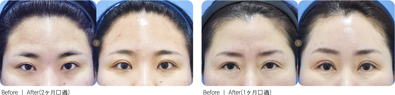 切開手術＋額リフト