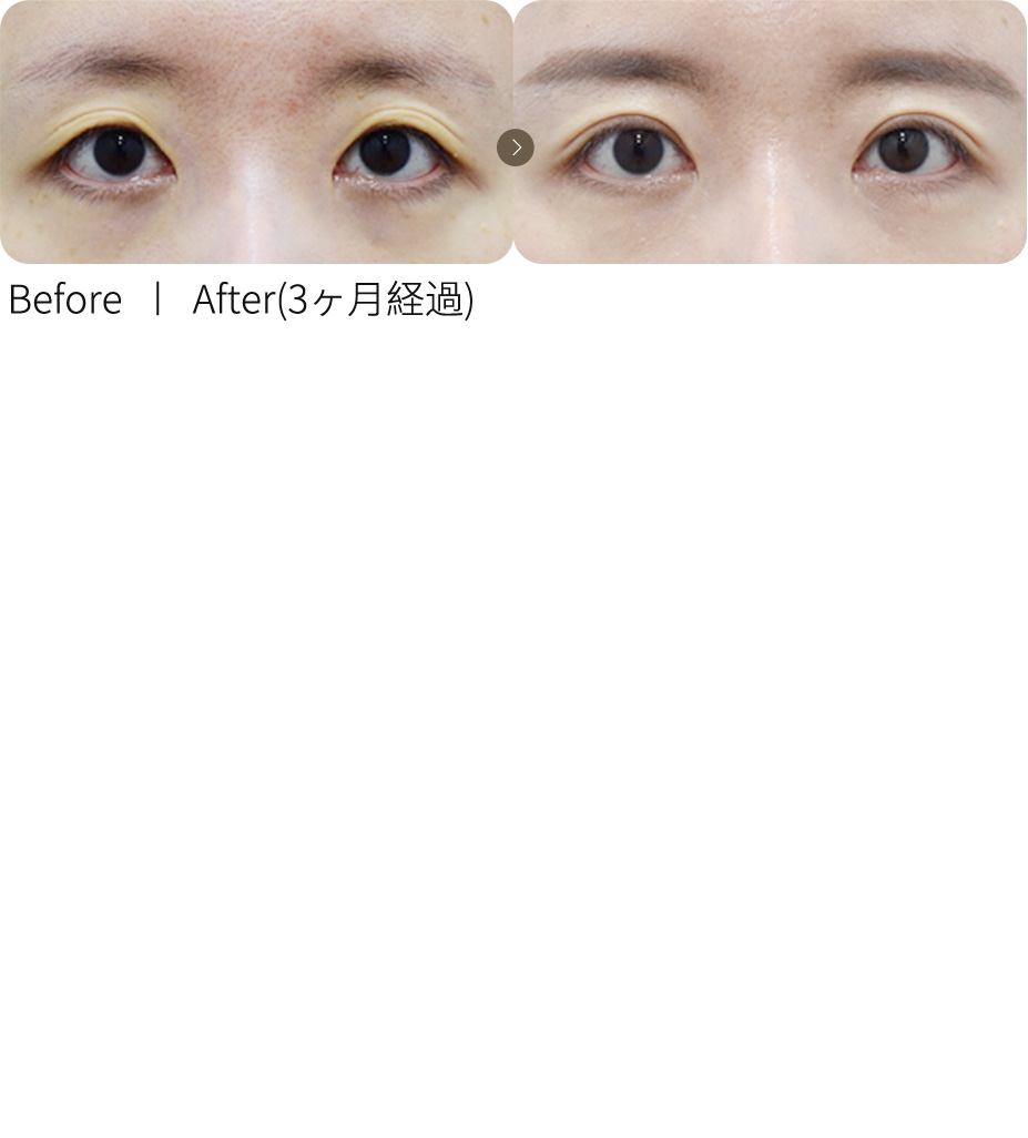 切開法再手術＋くぼみ目脂肪移植