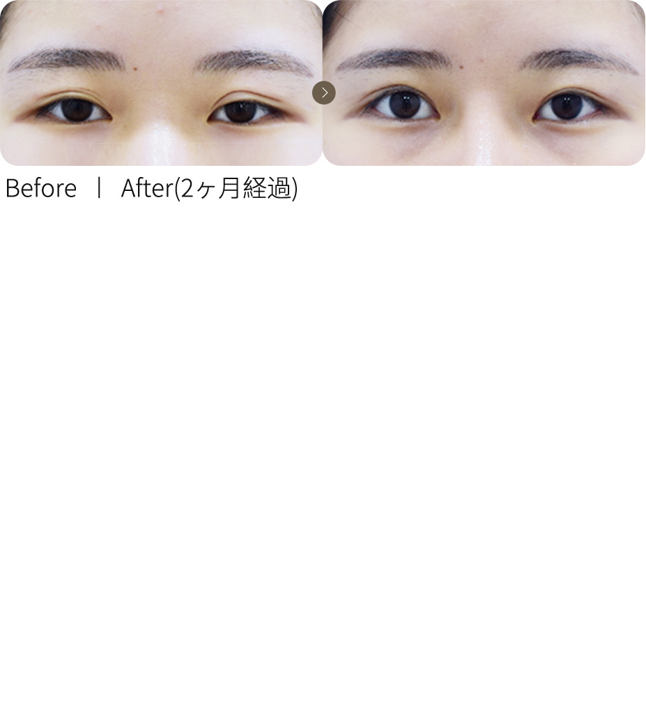 ラインを下げる施術