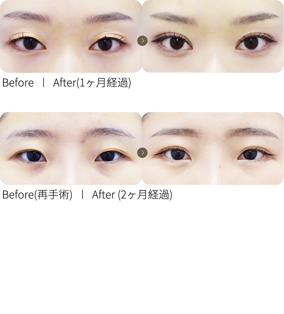 自然癒着二重整形