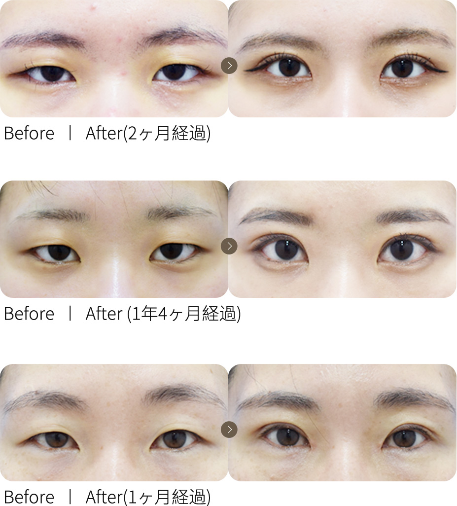 切開眼瞼矯正＋目頭切開