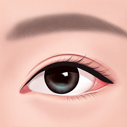 결막이 노출된 케이스 이미지