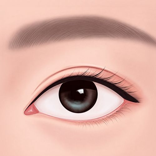 삼백안 증상이 나타난 케이스 이미지