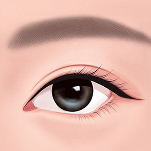 부자연스러운 눈꼬리 라인 케이스 이미지