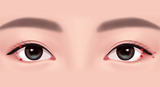 뒤트임 복원 수술 완성 눈매 이미지