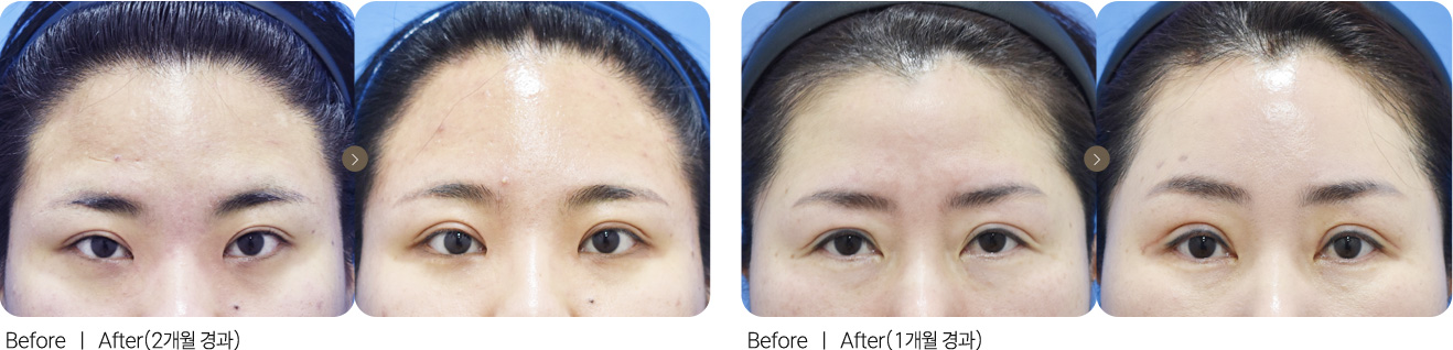 절개수술+이마거상