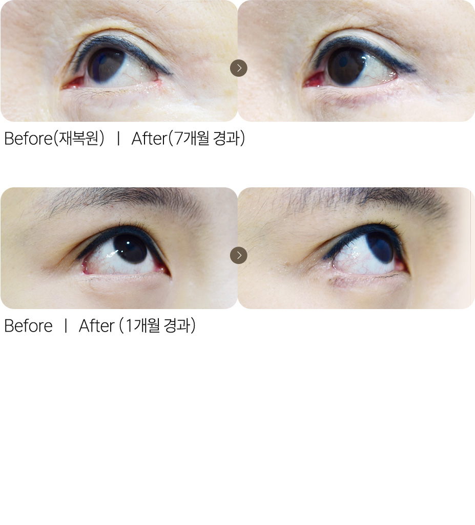 뒤트임복원재수술+러블리트임