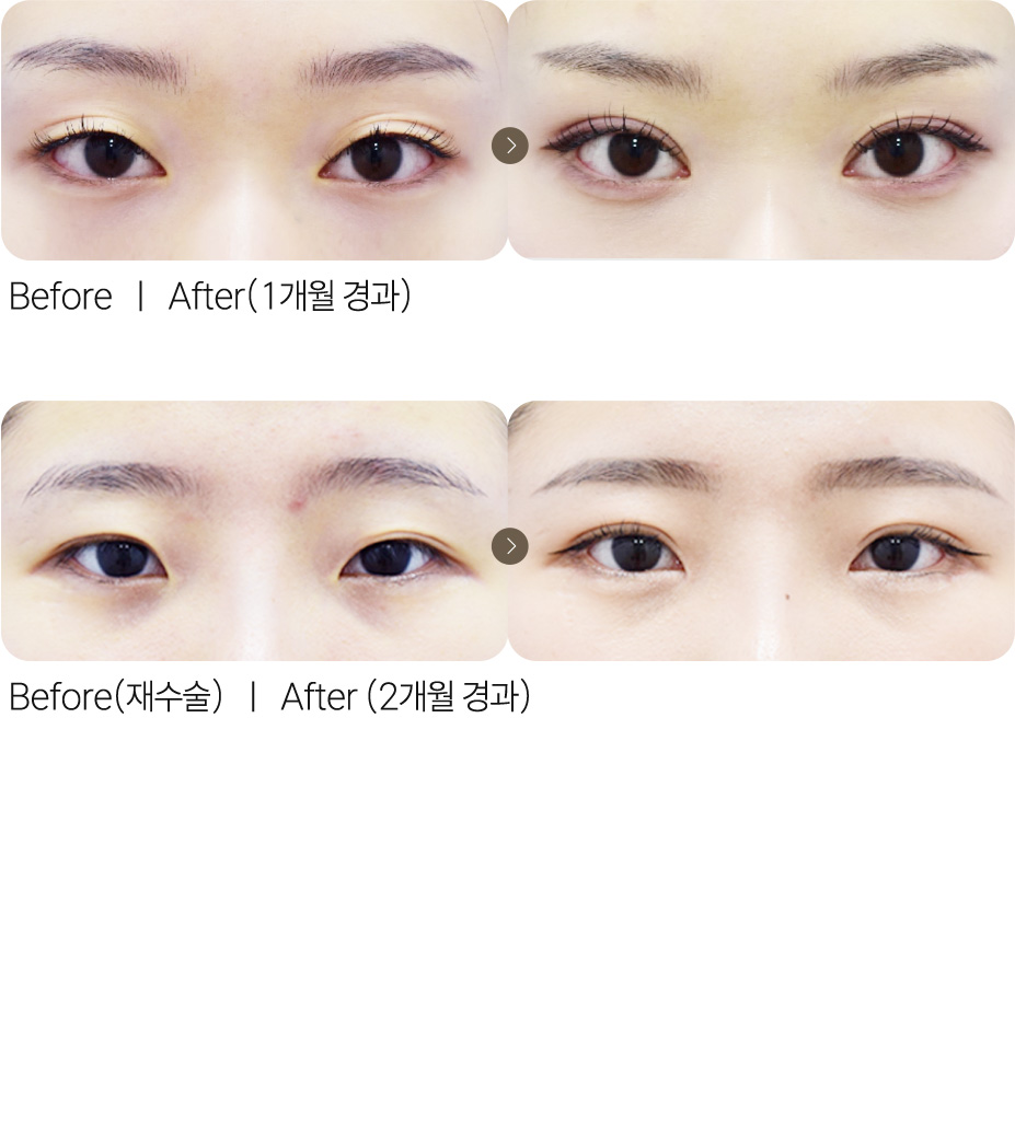 자연유착쌍꺼풀