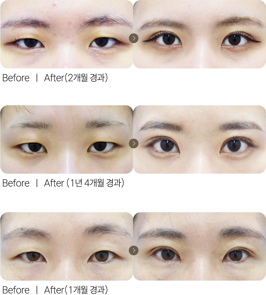 절개눈매교정+앞트임