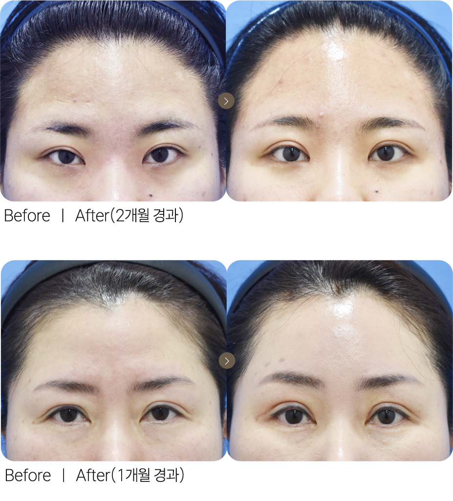 절개수술+이마거상